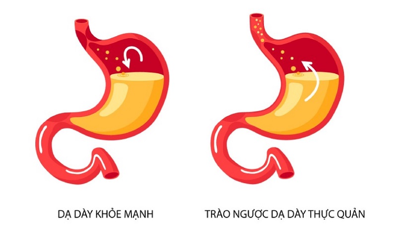 Bệnh trào ngược dạ dày khó chữa khỏi và thường xuyên tái phát